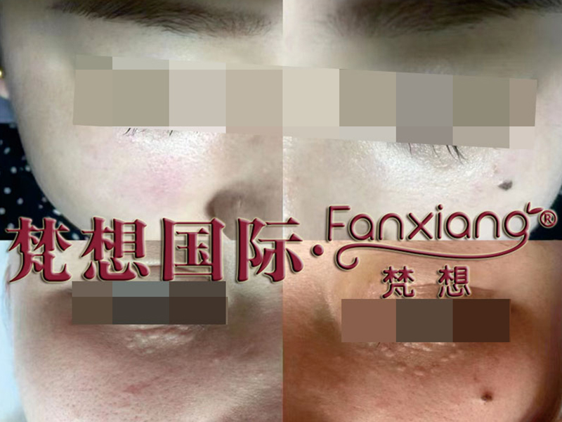 赘肉类案例