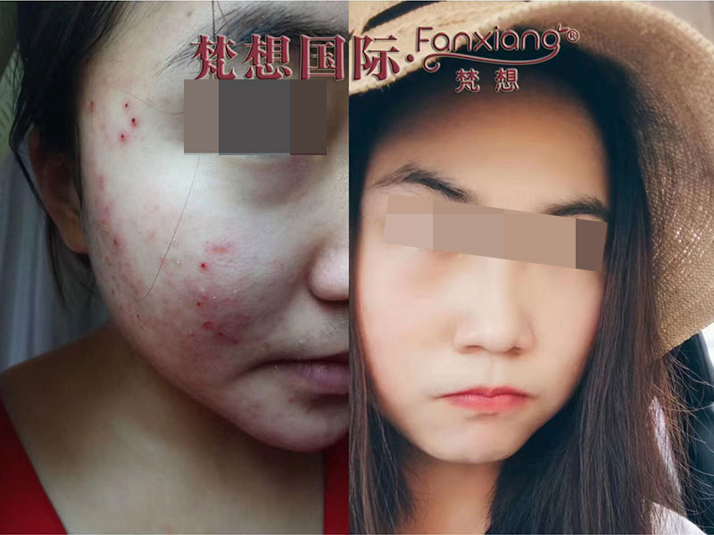 痘类案例